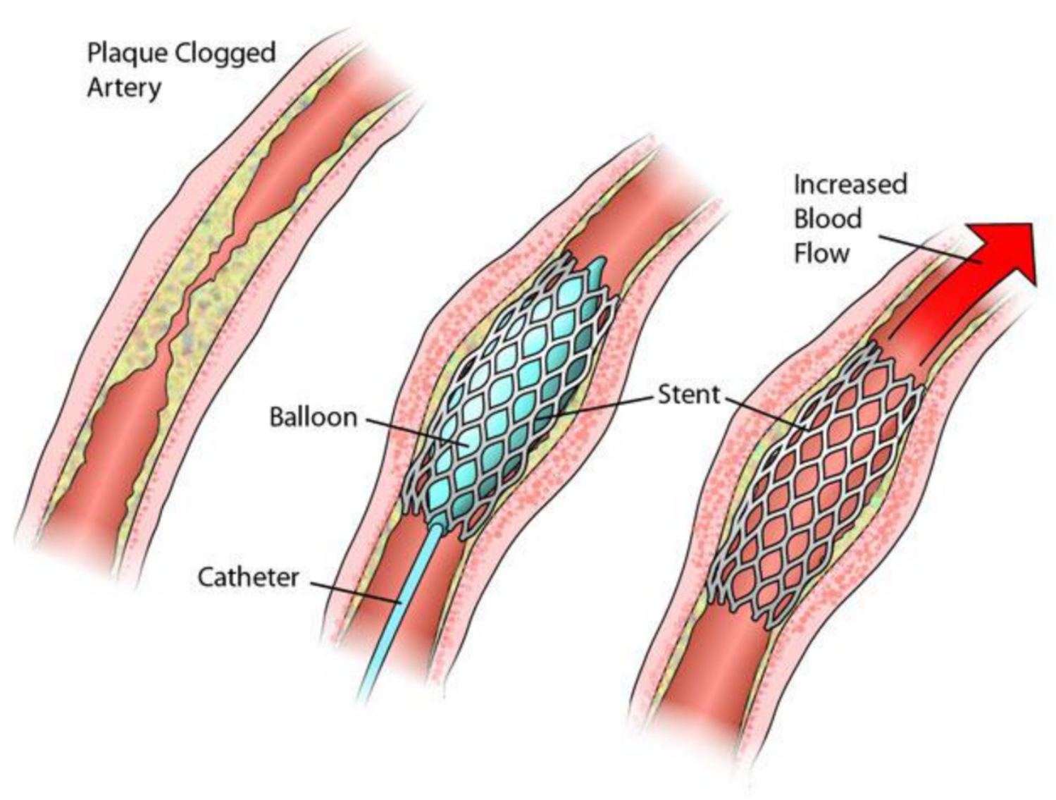 Nghiên cứu: Đặt stent động mạch cũng hiệu quả như phẫu thuật trong việc nong động mạch ở cổ.
